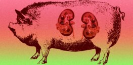 Second pig-to-human organ transplant: GM kidneys successfully implanted in a patient