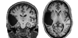 ‘I have an interesting brain’: The genius woman with a missing temporal lobe