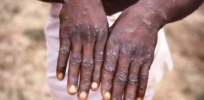Is monkeypox the next global viral scourge?