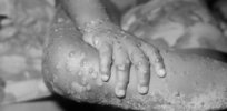 Should you be ‘crazy scared’ about monkeypox? Here’s why scientists say ‘no’