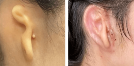3-D printed ears: First body part made with a person’s own cells