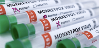 With monkeypox now an international public health emergency, what do you need to know?