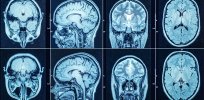 Mutiny: Here’s how glioblastoma uses the brain against itself to spread cancer and resist treatment