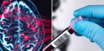 Ethical dilemma: Blood test can reveal dementia risk — but we are no closer to a cure