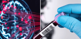 Ethical dilemma: Blood test can reveal dementia risk — but we are no closer to a cure
