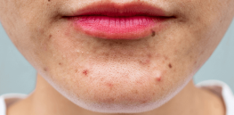 Acne affects half of people over 25 in Western countries — but it’s ‘basically nonexistent’ in non-industrialized societies. Why?