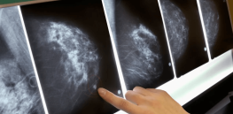 BRCA blood test: Simple blood sample can identify breast cancer developing up to two years before a formal diagnosis