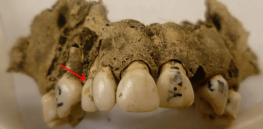 how dental plaque gives insight to our past