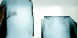 x ray photograph of lungs tissue involved by covid virus chernivtsi c ukraine