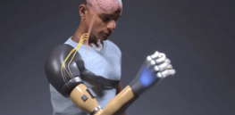 Bionic system allows man with above-elbow amputation to control every finger of a robotic arm