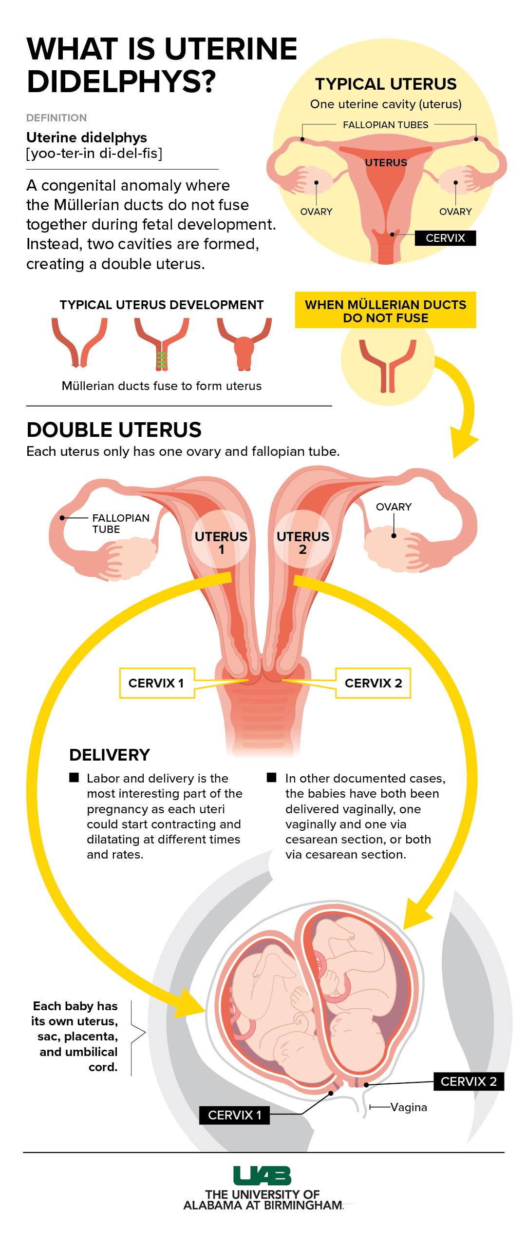 twin uterus graphic