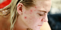 Acne treatment of the future: Gene-editing the bacteria that lives on your skin