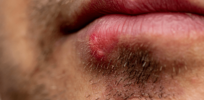 We thought herpes was untreatable. Now, that might change