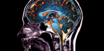 50,000 brain scans: AI has discovered five patterns of brain atrophy, providing insights into the mystery of aging