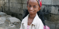 Progeria solution: Gene editing takes us one step closer to curing the disease that makes children rapidly age