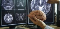 Free will and the brain: Challenges to long-standing belief that that addiction is a disease