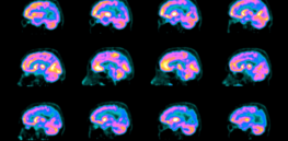 First-ever national surveillance system finds 5.4 million Medicare recipients have Alzheimer's
