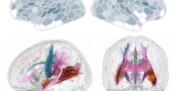 Why do many women develop postnatal depression? Brain scans can now help us understand