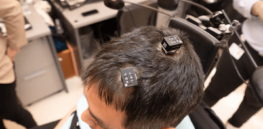 The first neural bypass implant powered by AI has helped a patient recover from near-full-body paralysis