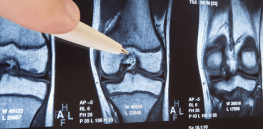45% of Americans will develop osteoporosis of the knee in their lifetime. How did evolution botch this?