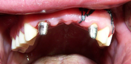 Missing teeth? A drug that that spurs regrowth shows promise