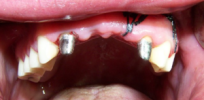 Missing teeth? A drug that that spurs regrowth shows promise