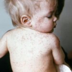 Small child with measles lesions covering his back, arms, and face