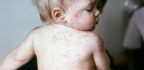 Small child with measles lesions covering his back, arms, and face
