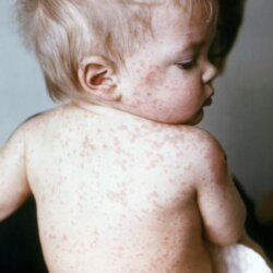 Small child with measles lesions covering his back, arms, and face