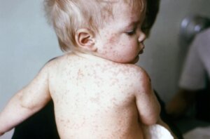 Small child with measles lesions covering his back, arms, and face