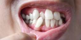 Broken smiles: Why have some humans evolved to have crooked teeth