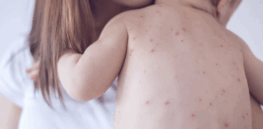 RFK, Jr. says ‘let measles run its course’. That’s what some said in 1990, and we had an urban health crisis