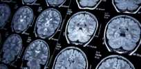 CRISPR brain ‘gene editing’ could open the door to cure neurological diseases