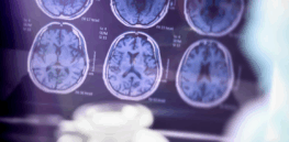 Scientists discover hidden brain protein, potentially leading to treating Alzheimer’s before symptoms even appear