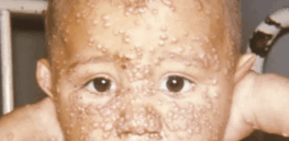 Anti-vaccination advocates romanticize over a safe pre-shot past that never existed