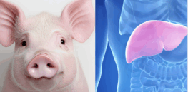 A liver extracted from a genetically modified pig transplanted into a 71-year-old man