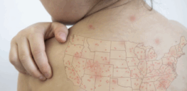 Vaccine rejectionism spurring continued surge in U.S. measles cases