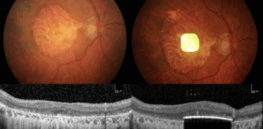 AI chip-powered retinal implant shown to help blind victims see again