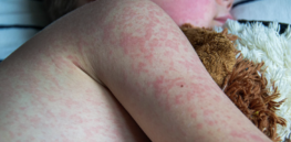 As U.S. measles cases surge to 2400+ since Trump took office, RFK, Jr. official proclaims ‘not really’ a concern