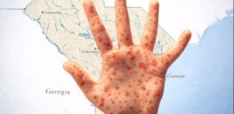 Viewpoint—'Stunningly stupid': RFK, Jr.’s measles non-existent measles containment policy