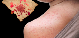 As measles cases soar in South Carolina, RFK, Jr.’s disciples lobby to gut vaccine mandates