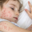 As vaccine rejectionism spreads, measles may be taking a more dangerous turn