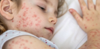 As vaccine rejectionism spreads, measles may be taking a more dangerous turn