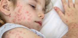 As vaccine rejectionism spreads, measles may be taking a more dangerous turn