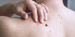 Viewpoint — ‘Completely unethical’: RFK, Jr.’s medical ignorance deprives melanoma cancer-sufferers of a life-saving therapy