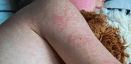 As measles vaccination rates collapse, scientists push for treatments long considered unnecessary