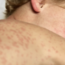 Viewpoint: Childhood deaths in dispute: Why the CDC vs Pennsylvania conflict over measles vaccines matters