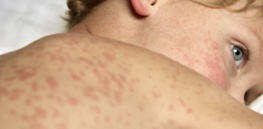 Viewpoint: Childhood deaths in dispute: Why the CDC vs Pennsylvania conflict over measles vaccines matters