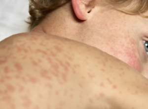 Viewpoint: Childhood deaths in dispute: Why the CDC vs Pennsylvania conflict over measles vaccines matters