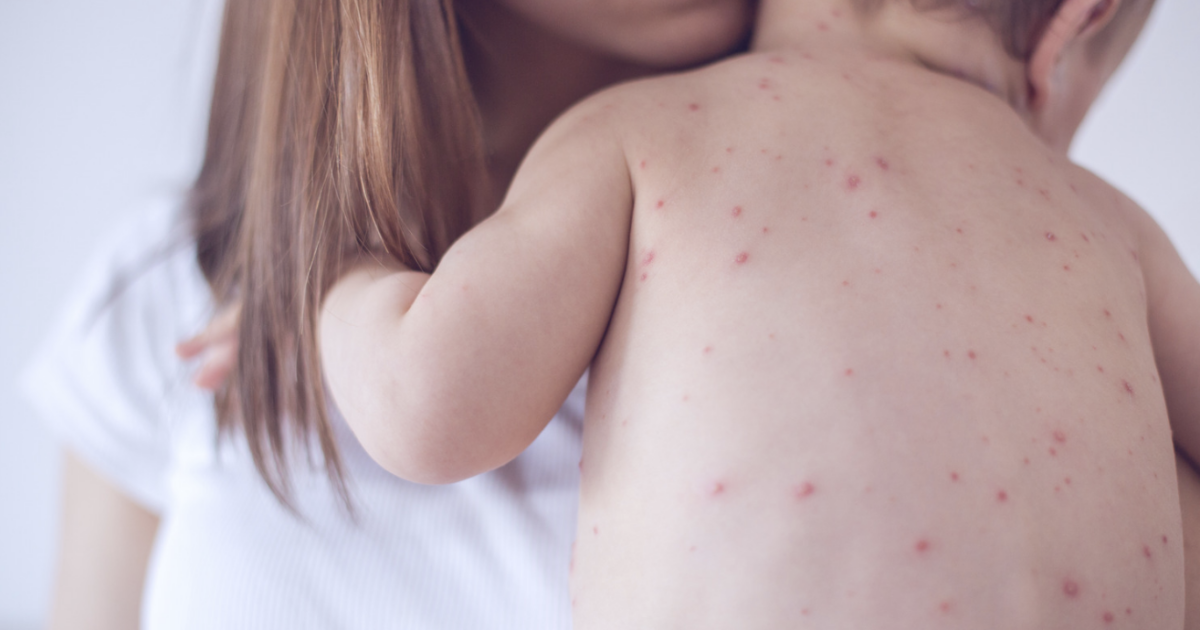 What constitutes a measles death? RFK, Jr. maneuvers to restrict definition to make pandemic seem less dire